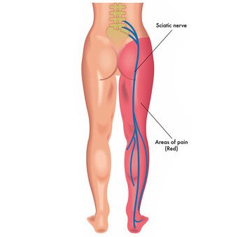 symptoms of Sciatica pain 