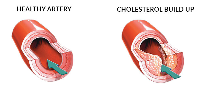 Blood cholesterol as risk factor heart disease 