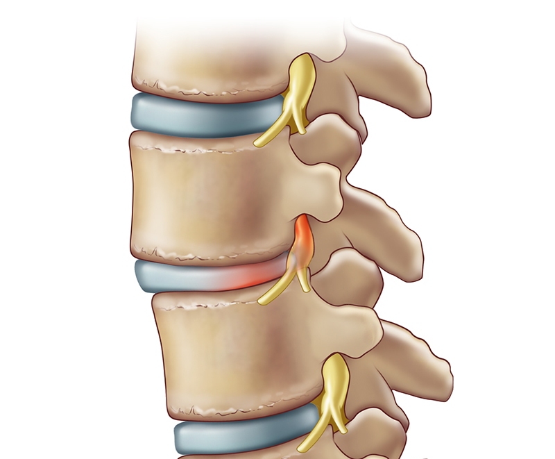 causes of Sciatic Pain 