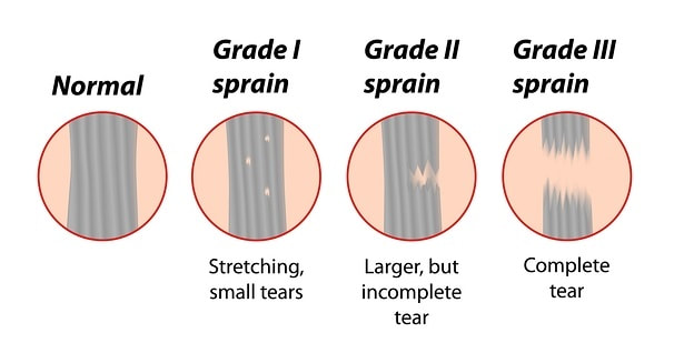Grades of Hip Flexor Strain