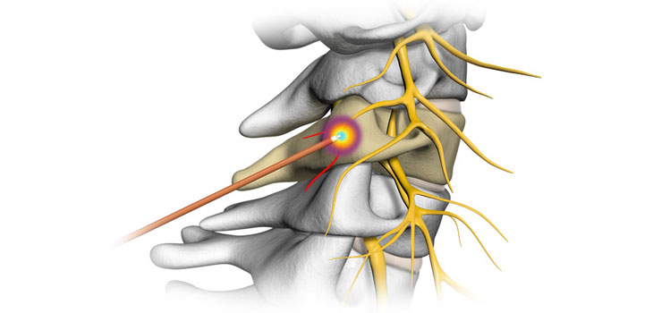Radiofrequency Ablation 