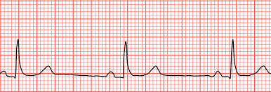 bradycardia low heart rate