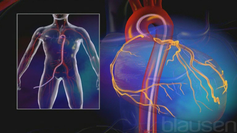 coronary angiography