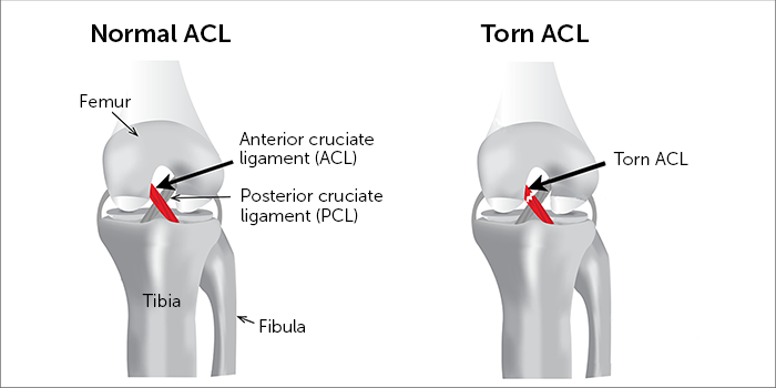 ACL surgery