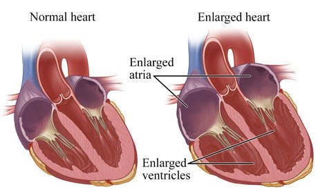 cardiomegaly disease