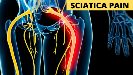 causes and prevention of sciatica pain