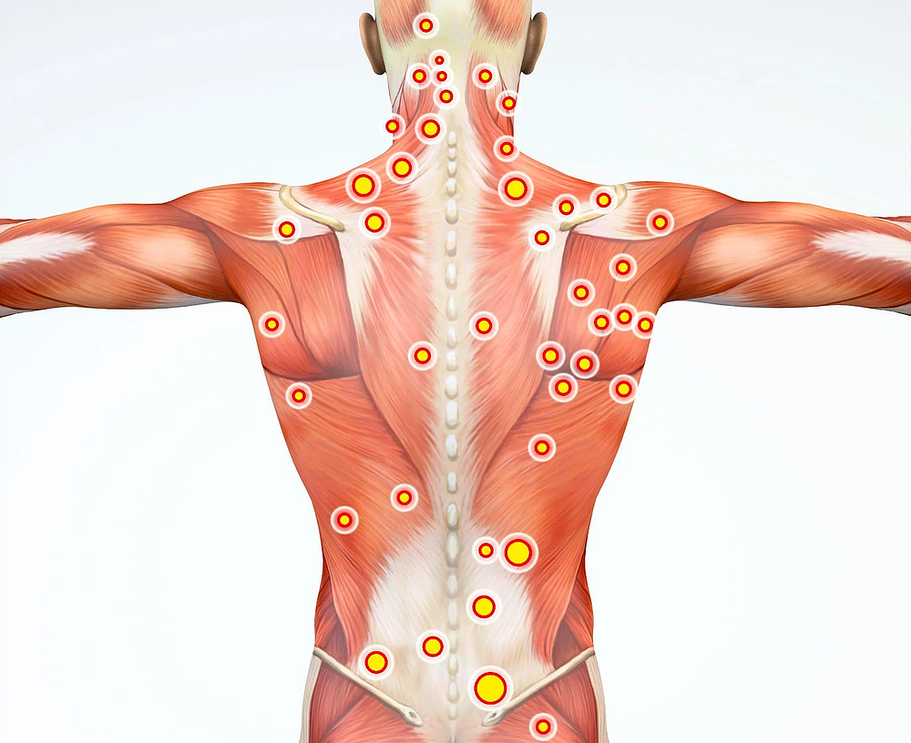 muscle knots causes and symptoms