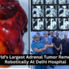 Doctors at Safdarjung Hospital performing India's first CAR T-cell therapy and robotic removal of the world’s largest adrenal tumour.